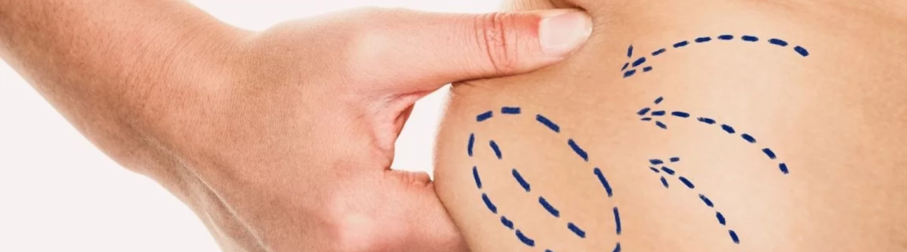 Liposuction Surgery