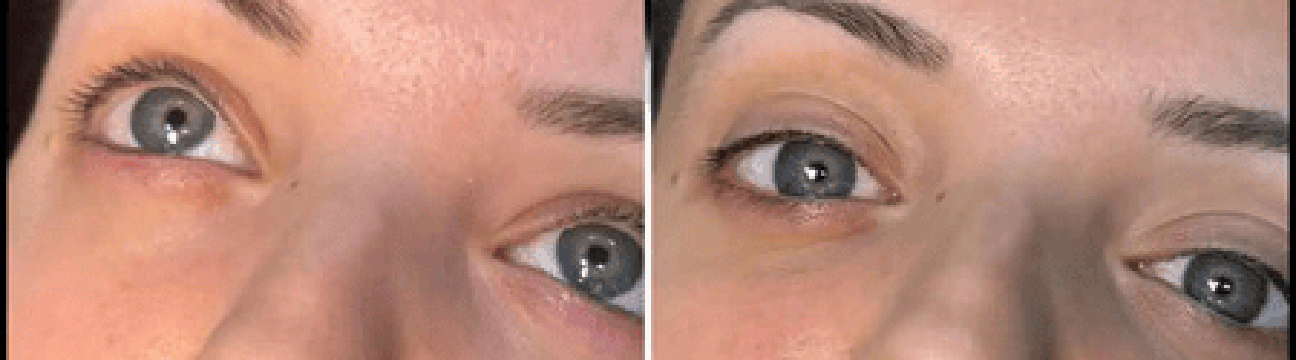 Dermal Fillers