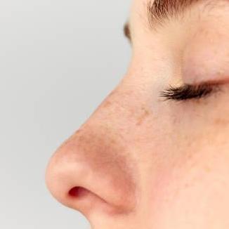 Rhinoplasty  In Riyadh