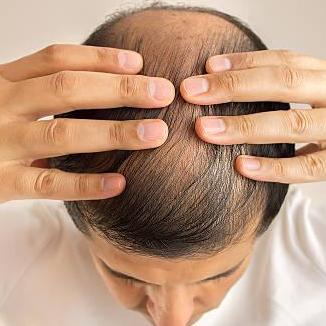 Hair Transplant  In Riyadh